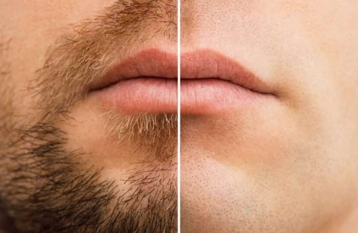 050-blog-hombre-barba-depilada-antes-despues-1024x538-1